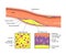 Artery atheroma plaque