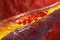 Artery clog: atherosclerosis - the cholesterol buildup in arteries, its risks, and strategies for prevention and