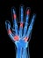 Arthritic hand