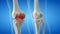 An arthritic knee joint