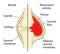 Arthritic knee joint