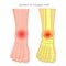 Arthritis of the ankle joint