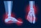 Arthritis foot concept