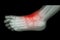 Arthritis and injury at ankle : film x-ray of child\'s foot ( side view ) ( lateral )