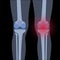 Arthritis in knee joint