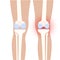 Arthritis in knee joint