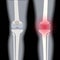 Arthritis in knee joint