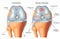 Arthrosis of the knee