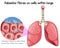 Asbestos Fibres on Cells Within Lungs
