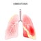 Asbestosis. Close-up of a cross section of human lungs with fibrosis and scarring