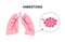 Asbestosis lung disease