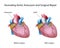 Ascending aortic aneurysm