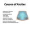 Ascites Free fluid in the abdominal cavity. Infographics. Vector illustration on isolated background.