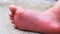 Asian child girl `s right foot with red rash and swelling from a bee sting , inflammation allergy on skin background