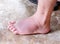 Asian foot man injured on ankle pain with bruises accident from falling stairs