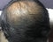 Asian head showing hair fall and hair loss