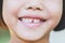 Asian kid`s decayed teeth
