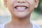 Asian kid`s decayed teeth