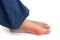 Asian man with swollen deformed inflammed toe joint with painful gout