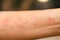 Asian woman has red rash on her left arm