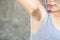 Asian woman having problem fat skin  underarm and black armpit