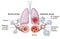 Asthma, normal and asthmatic airways, medically illustration