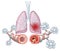 Asthma, normal and asthmatic airways, medically illustration