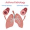 Asthma pathology