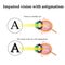 Astigmatism. As the eye can see with astigmatism. Impaired vision