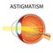 Astigmatism. Eyesight problem, blurred vision.