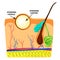 Atheroma structure. The structure of moles on the skin. Infographics. Vector illustration on isolated background.