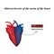 Atherosclerosis of the arteries of the heart. Infographics. Vector illustration
