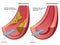 Atherosclerosis & Arteriosclerosis