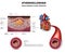 Atherosclerosis. Fibrous plaque formation