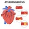 Atherosclerosis. The formation of fibrous plaque.  Infographics. Cholesterol in human blood vessels and heart logo. Fat cells in v