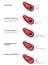 Atherosclerosis illustration