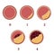 Atherosclerosis stages 1