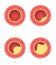 Atherosclerosis stages in artery