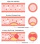 Atherosclerosis stages: healthy artery, plaque formation, and thrombosis in flat style isolated on white background. health care c