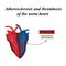 Atherosclerosis and thrombosis of arteries of the heart. Infographics. Vector illustration