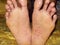 Athlete`s foot disease