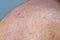 Atocpic dermatitis symptoms on the right shoulder