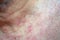 Atocpic dermatitis symptoms on the upper chest