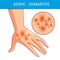 Atopic dermatis. The person scratches the arm on which is atopic dermatitis. Itching.