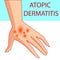Atopic dermatis. The person scratches the arm on which is atopic dermatitis. Itching.