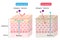 Atopic dermatitis eczema dry and normal skin cell layer  illustration. Before and after. Healthy and beauty skin care concept