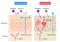 Atopic dermatitis eczema and normal skin cell illustration. Healthy skin care concept