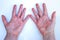 Atopic Dermatitis, Red hands, Dermatological problem, Female hands, Allergy and itching, Minimal concept, White background