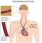 Atrial fibrillation and stroke