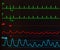 Atrial Flutter with Variable Conduction